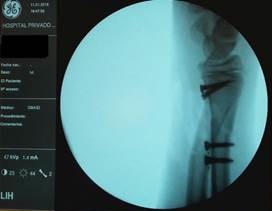 Implantes-traslúcidos-Postoperatorio-Grupo-Gamma