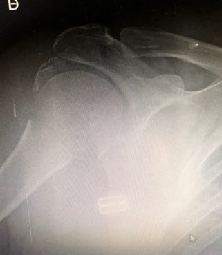 fractura-a-4-fragmentos-humero-proximal-Grupo-Gamma-321x369