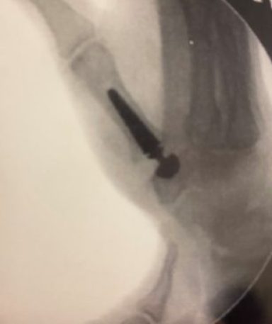 Rizartrosis-Prótesis-308x369